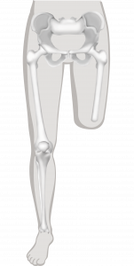 Illustratie van bovenbeenamputatie of transfemorale amputatie