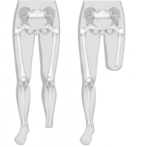 Illustratie van een voetamputatie en een bovenbeenamputatie