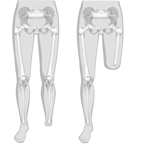 Illustratie van een voetamputatie en een bovenbeenamputatie