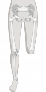 Illustratie van een knieëxarticulatie zonder prothese