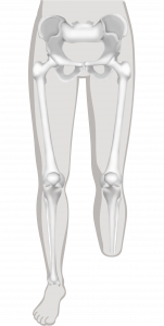 Illustratie van een onderbeenamputatie zonder prothese